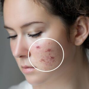 Woman with acne skin issue
