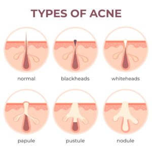 Acne types anatomy. Pimple diseases sectional view blackhead, cystic and whitehead